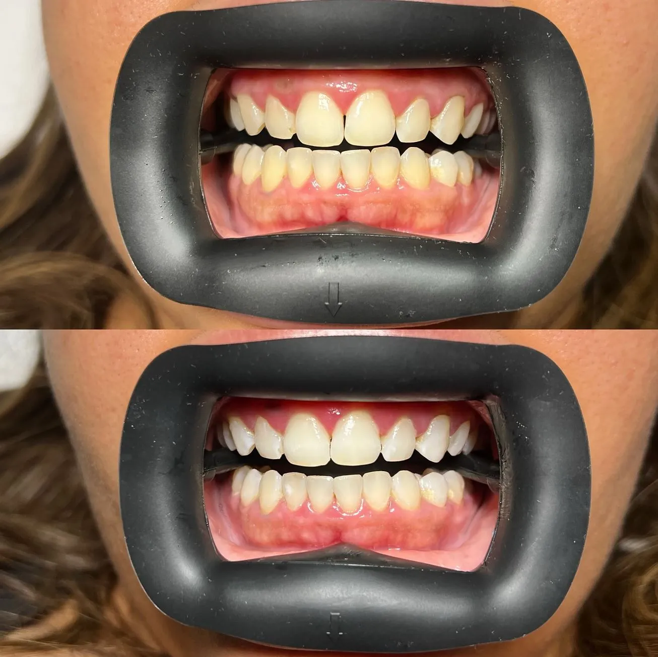 Do You Need Qualifications to Offer Teeth Whitening Services