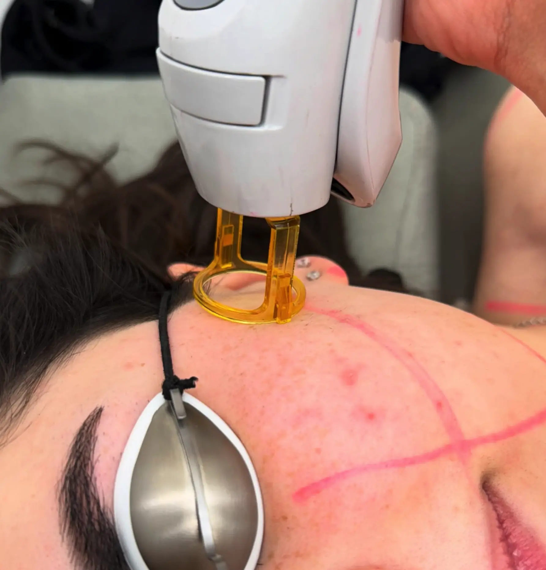 Non-ionising radiation laser