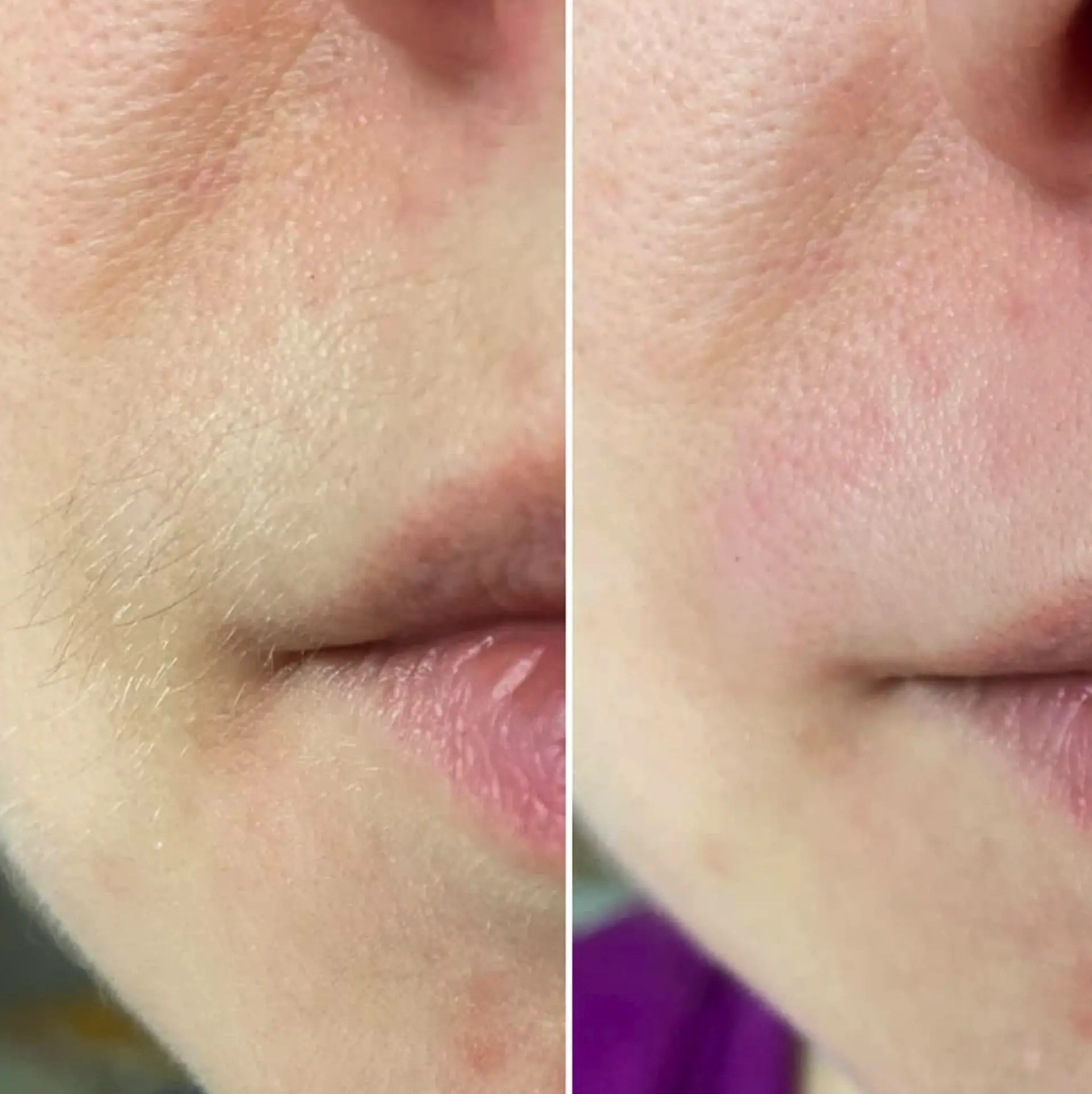 Side effects of laser hair removal