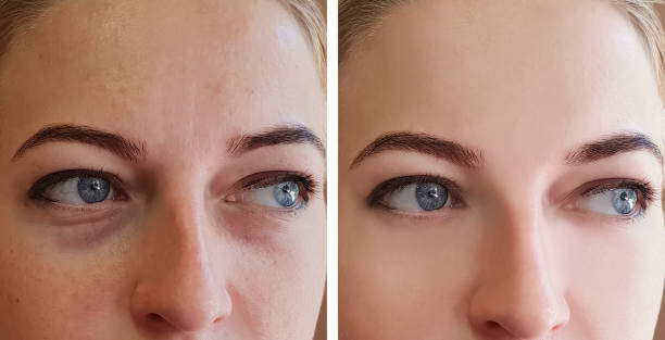 Before and after comparison of eyebrow enhancement on a woman