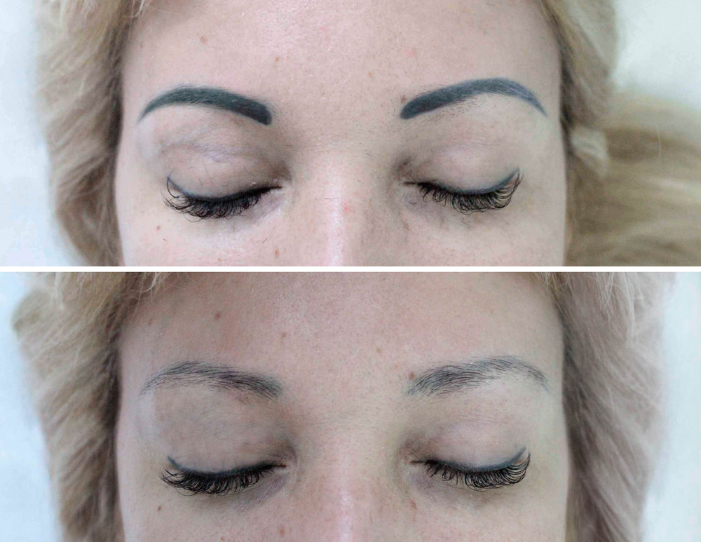 saline eyebrow tattoo removal