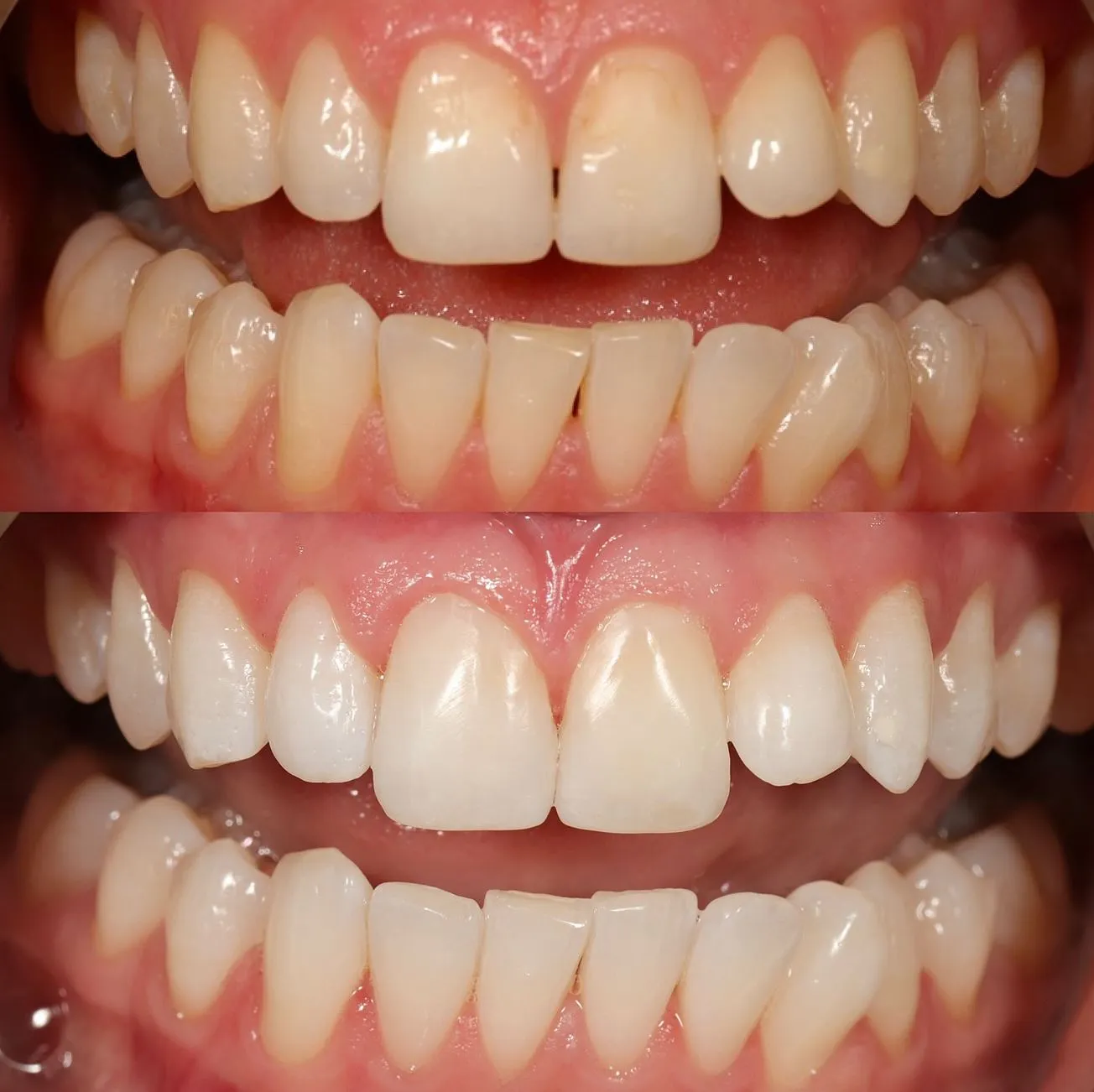 teeth whitening training